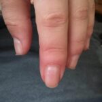 Opuchlizna palca po drzazdze co robić